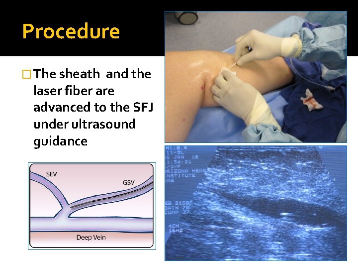 Procedure � The sheath and the laser fiber are advanced to the SFJ under