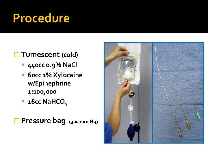 Procedure � Tumescent (cold) 440 cc 0. 9% Na. Cl 60 cc 1% Xylocaine