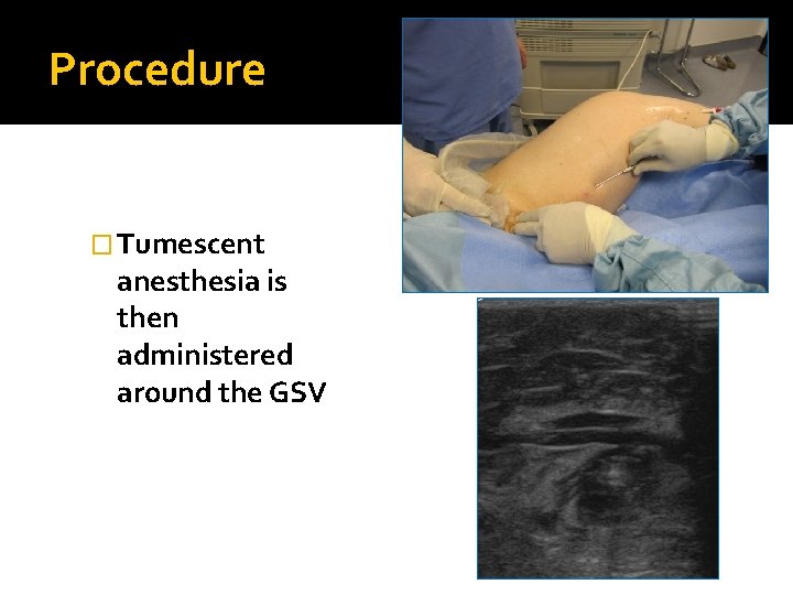 Procedure � Tumescent anesthesia is then administered around the GSV 