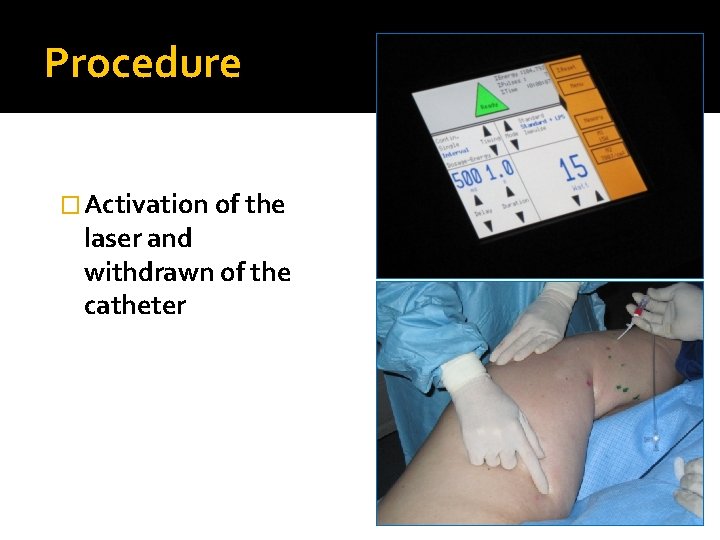 Procedure � Activation of the laser and withdrawn of the catheter 