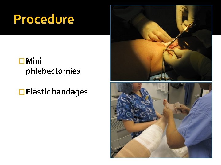 Procedure � Mini phlebectomies � Elastic bandages 