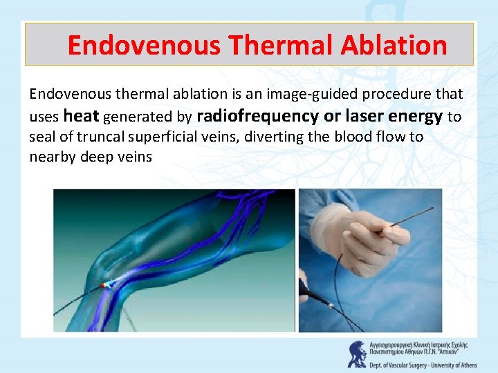 Endovenous Τhermal Αblation Endovenous thermal ablation is an image-guided procedure that uses heat generated