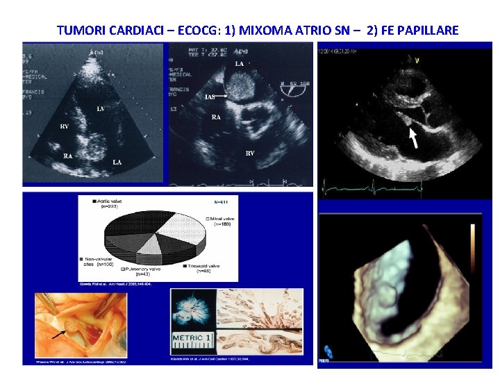 TUMORI CARDIACI – ECOCG: 1) MIXOMA ATRIO SN – 2) FE PAPILLARE 