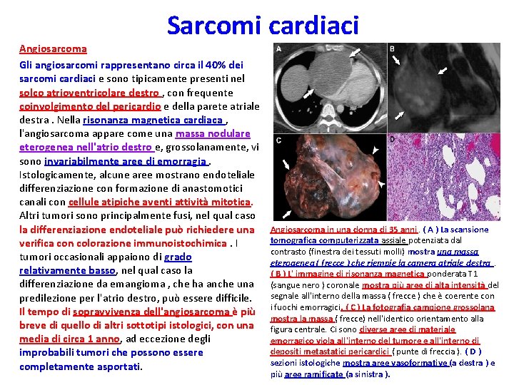 Sarcomi cardiaci Angiosarcoma Gli angiosarcomi rappresentano circa il 40% dei sarcomi cardiaci e sono