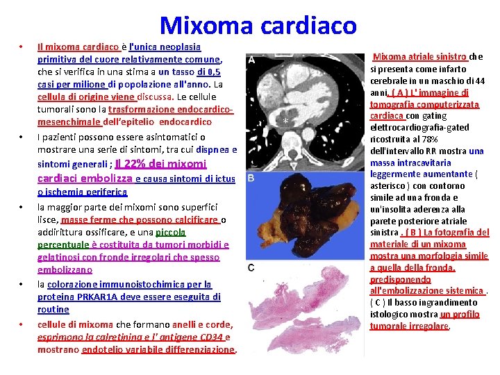  • • • Mixoma cardiaco Il mixoma cardiaco è l'unica neoplasia primitiva del