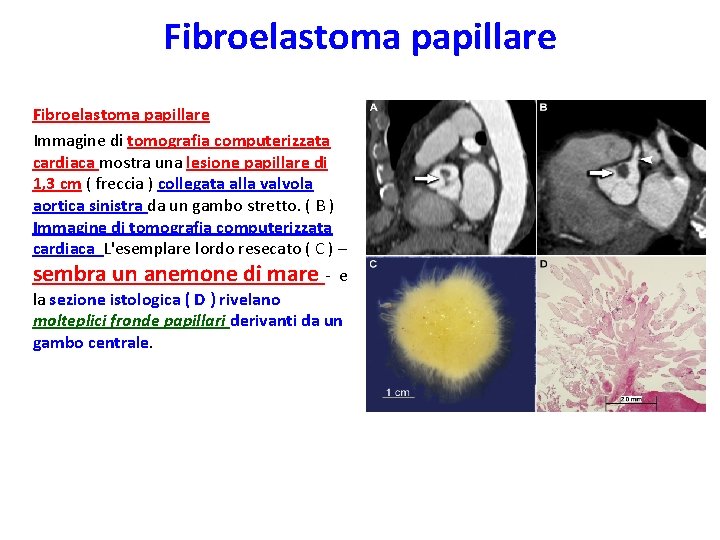 Fibroelastoma papillare Immagine di tomografia computerizzata cardiaca mostra una lesione papillare di 1, 3