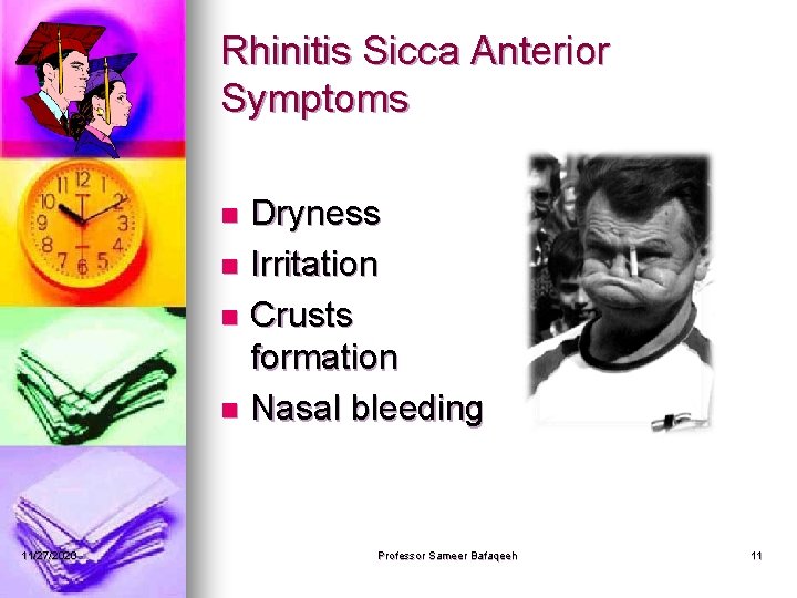 Rhinitis Sicca Anterior Symptoms Dryness n Irritation n Crusts formation n Nasal bleeding n