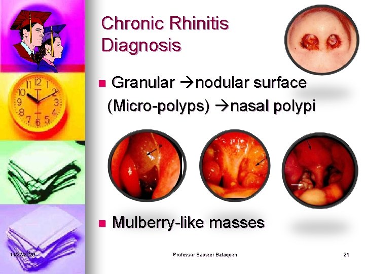 Chronic Rhinitis Diagnosis Granular nodular surface (Micro-polyps) nasal polypi n n 11/27/2020 Mulberry-like masses