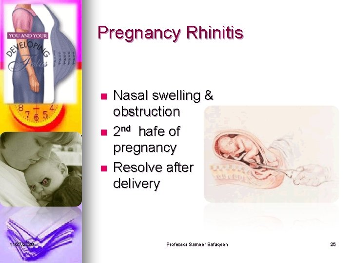 Pregnancy Rhinitis n n n 11/27/2020 Nasal swelling & obstruction 2 nd hafe of