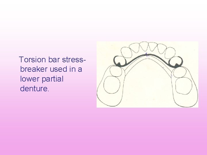 Torsion bar stress breaker used in a lower partial denture. Torsion bar stress breaker used in a lower partial denture.