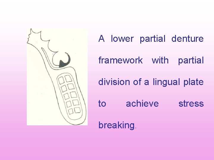 A lower partial denture framework with partial division of a lingual plate to achieve A lower partial denture framework with partial division of a lingual plate to achieve