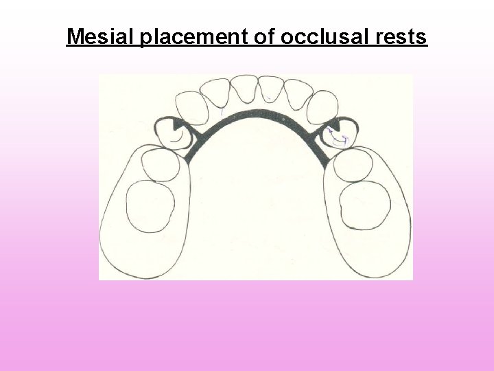 Mesial placement of occlusal rests Mesial placement of occlusal rests