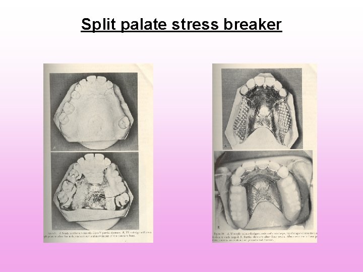 Split palate stress breaker Split palate stress breaker