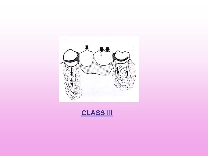 CLASS III CLASS III