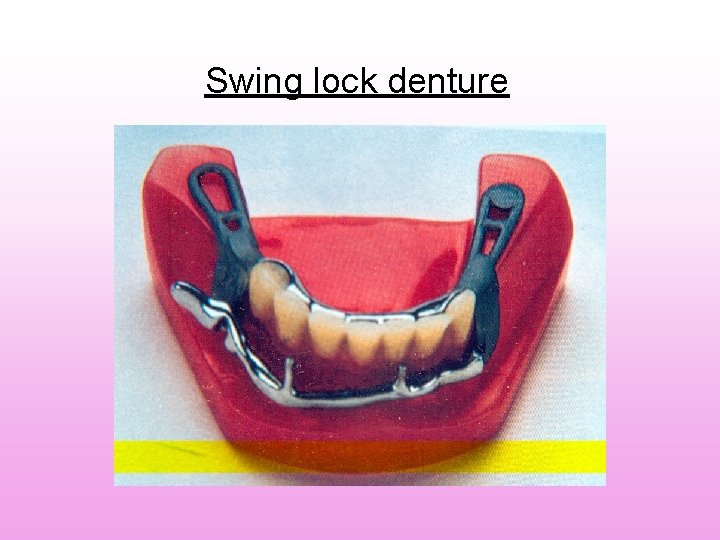 Swing lock denture Swing lock denture