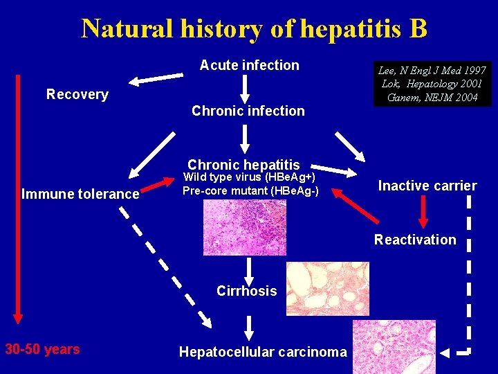 Natural history of hepatitis B Acute infection Recovery Chronic infection Lee, N Engl J
