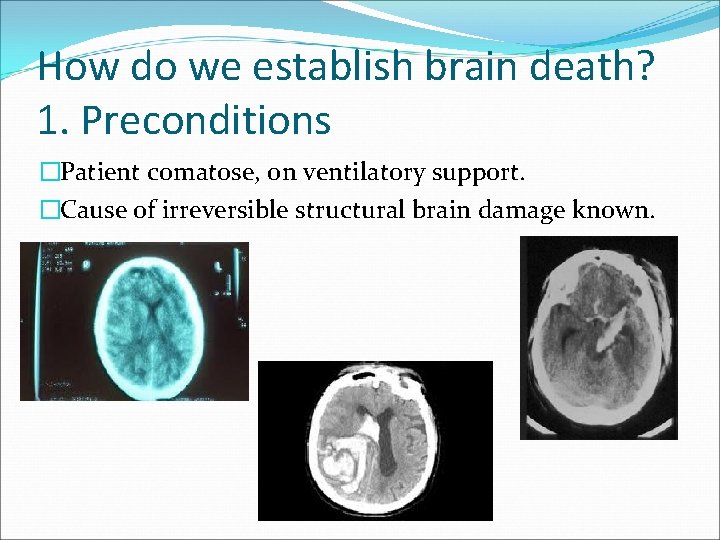 How do we establish brain death? 1. Preconditions �Patient comatose, on ventilatory support. �Cause