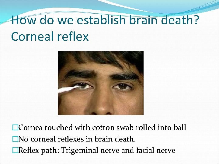 How do we establish brain death? Corneal reflex �Cornea touched with cotton swab rolled