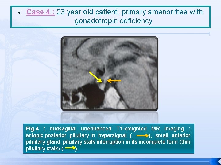  Case 4 : 23 year old patient, primary amenorrhea with gonadotropin deficiency Fig.