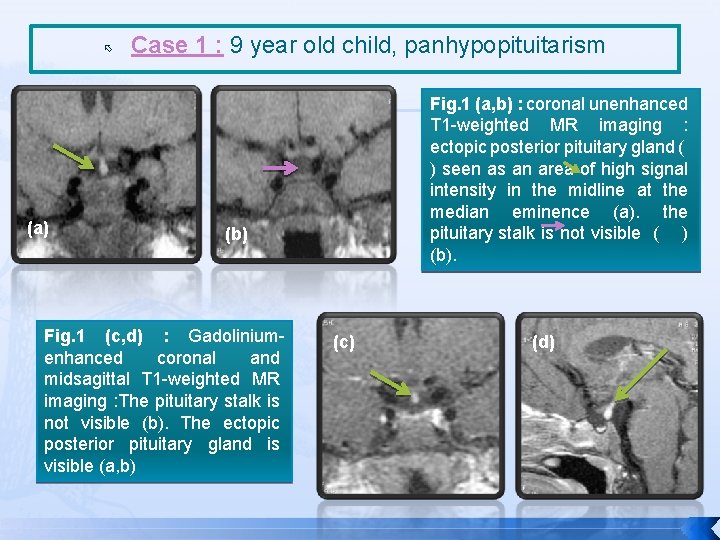  (a) Case 1 : 9 year old child, panhypopituitarism Fig. 1 (a, b)