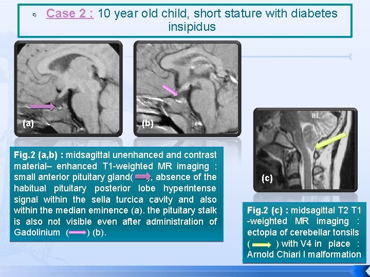  (a) Case 2 : 10 year old child, short stature with diabetes insipidus