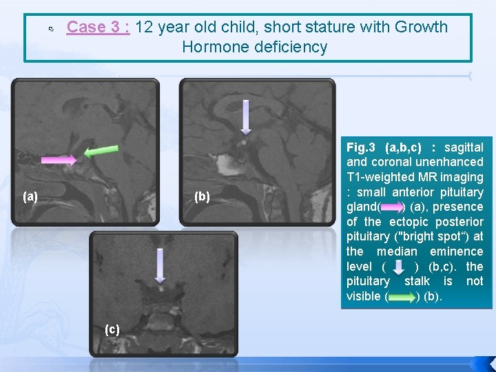  Case 3 : 12 year old child, short stature with Growth Hormone deficiency