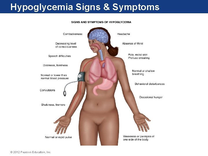 Hypoglycemia Signs & Symptoms © 2012 Pearson Education, Inc. 