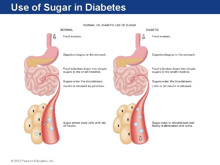 Use of Sugar in Diabetes © 2012 Pearson Education, Inc. 