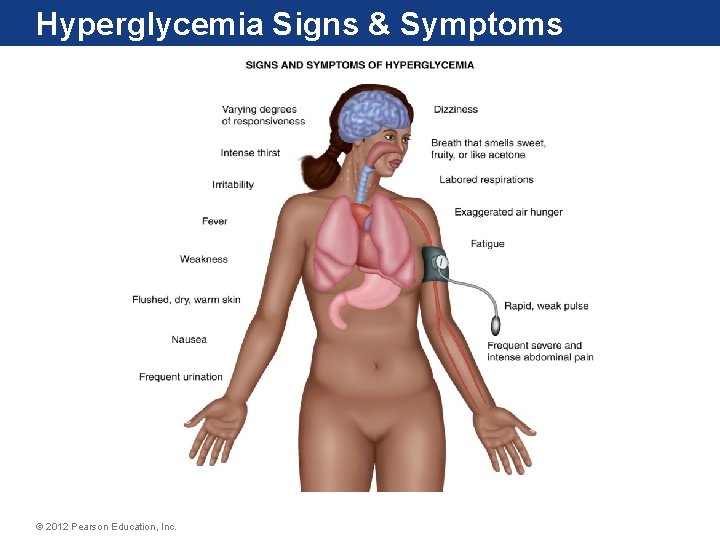 Hyperglycemia Signs & Symptoms © 2012 Pearson Education, Inc. 