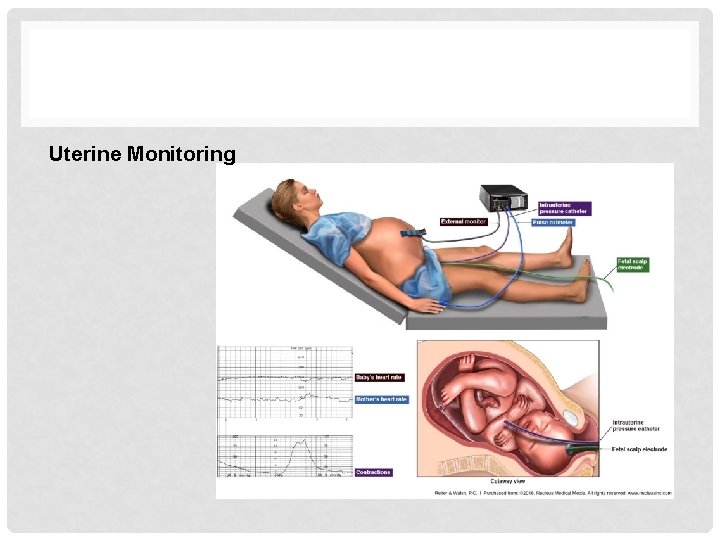 Uterine Monitoring 