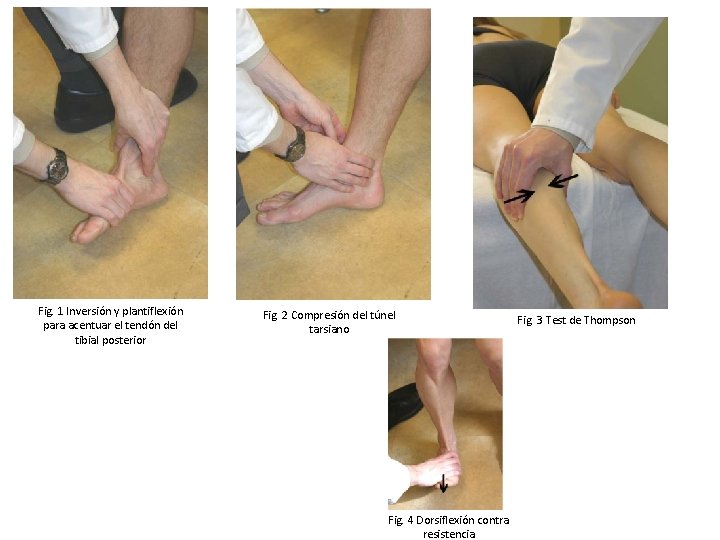 Fig. 1 Inversión y plantiflexión para acentuar el tendón del tibial posterior Fig. 2