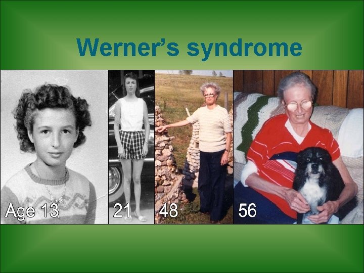 Werner’s syndrome Werner’s syndrome