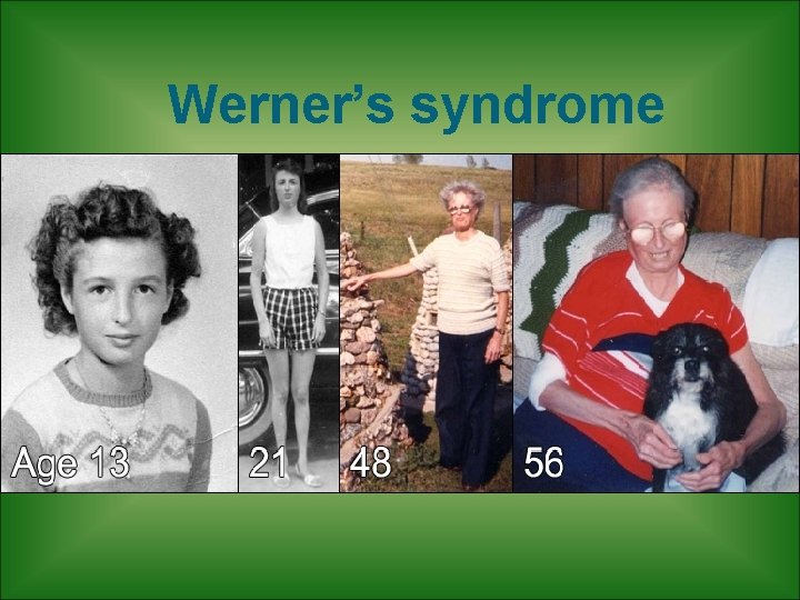 Werner’s syndrome 