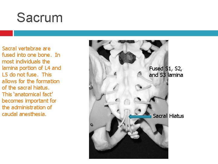 Sacrum Sacral vertebrae are fused into one bone. In most individuals the lamina portion