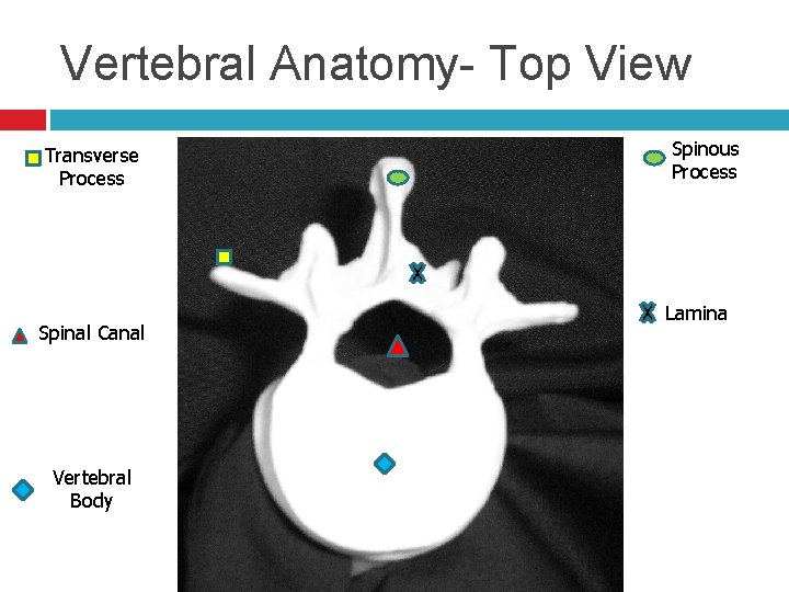 Vertebral Anatomy- Top View Transverse Process Spinal Canal Vertebral Body Spinous Process Lamina 