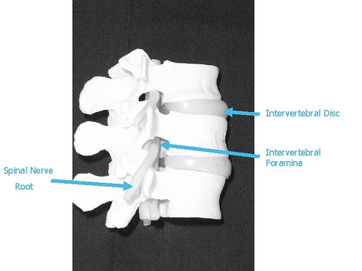 Intervertebral Disc Spinal Nerve Root Intervertebral Foramina 