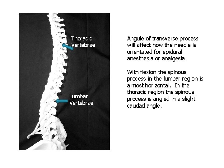Thoracic Vertebrae Lumbar Vertebrae Angule of transverse process will affect how the needle is