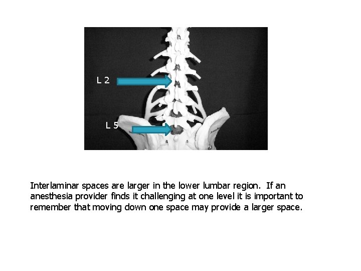 L 2 L 5 Interlaminar spaces are larger in the lower lumbar region. If