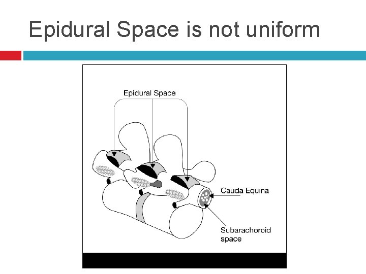 Epidural Space is not uniform 