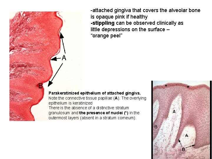 -attached gingiva that covers the alveolar bone is opaque pink if healthy -stippling can