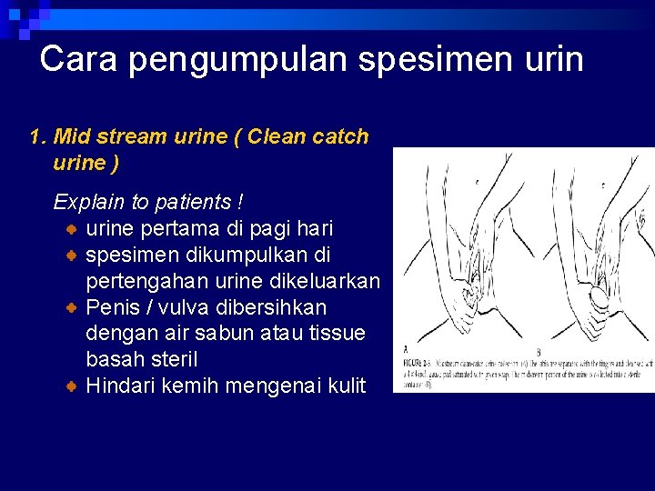 Cara pengumpulan spesimen urin 1. Mid stream urine ( Clean catch urine ) Explain