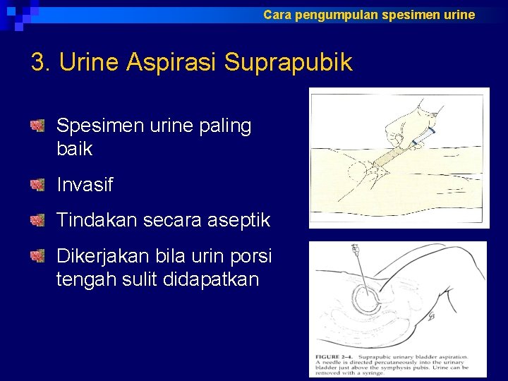 Cara pengumpulan spesimen urine 3. Urine Aspirasi Suprapubik Spesimen urine paling baik Invasif Tindakan