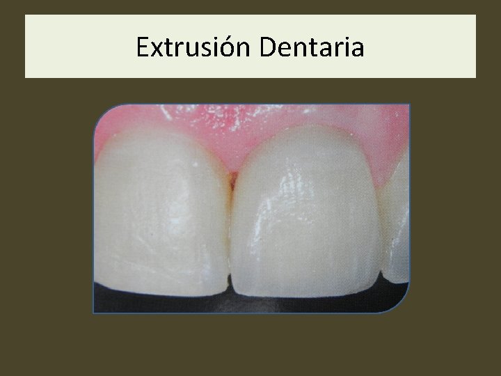 Extrusión Dentaria 