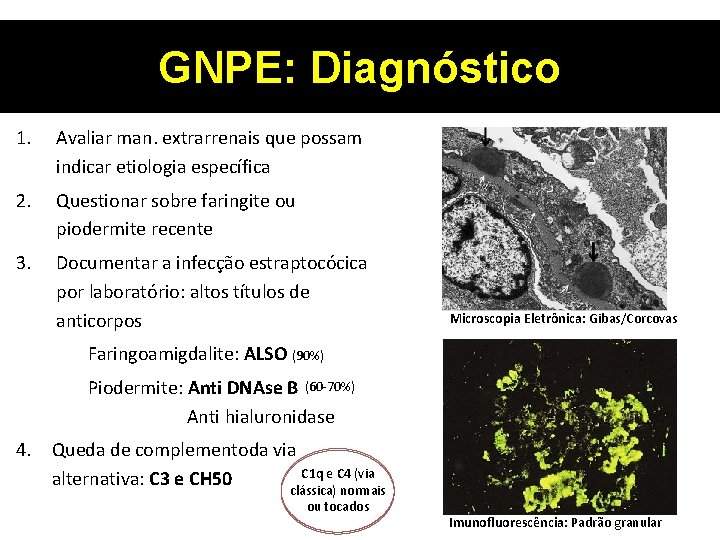 GNPE: Diagnóstico 1. Avaliar man. extrarrenais que possam indicar etiologia específica 2. Questionar sobre