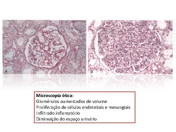 Microscopia ótica: Glomérulos aumentados de volume Proliferação de células endoteliais e mesangiais Infiltrado inflamatório