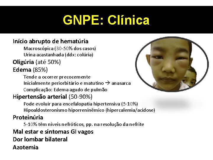 GNPE: Clínica Início abrupto de hematúria Macroscópica (30 -50% dos casos) Urina acastanhada (ddx: