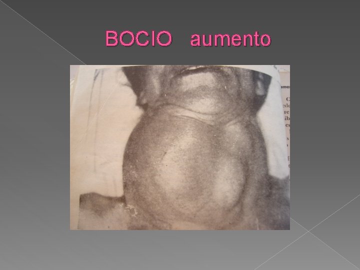 BOCIO aumento 