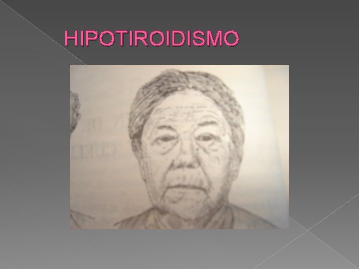 HIPOTIROIDISMO 