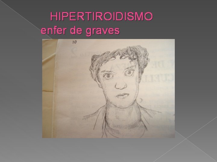 HIPERTIROIDISMO enfer de graves 