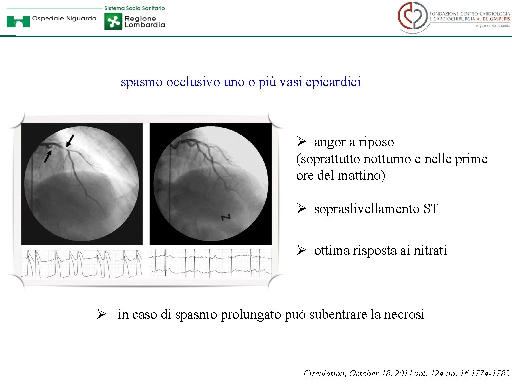 spasmo occlusivo uno o più vasi epicardici Ø angor a riposo (soprattutto notturno e